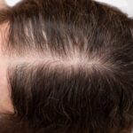 Pérdida del cabello y menopausia